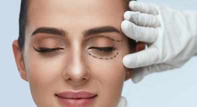 blepharoplasty surgery image