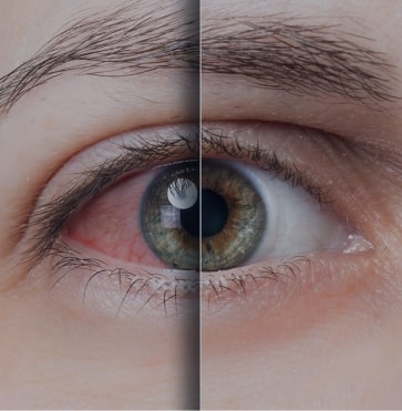 dry-eye-syndrom
