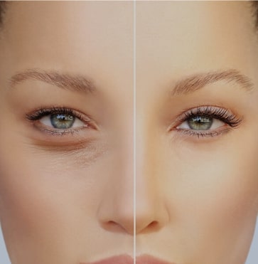 blepharoplasty