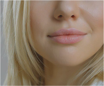 juvederm