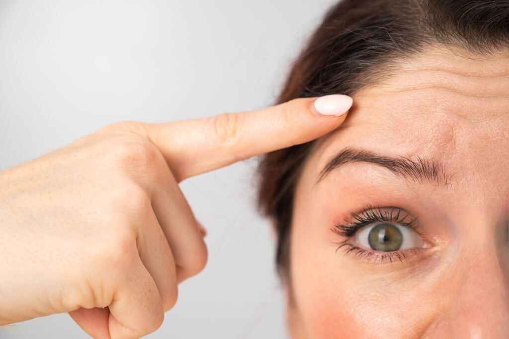 brow-lift