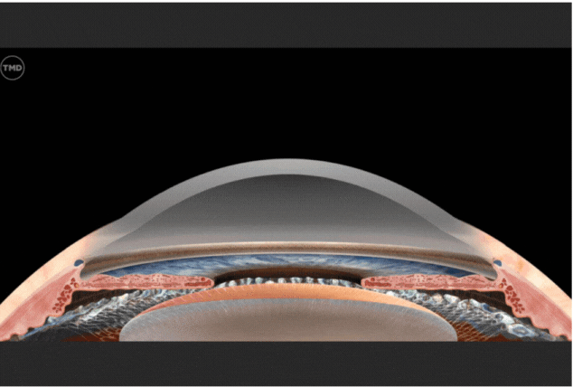 LensReplacement