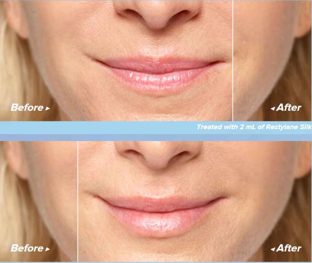 restylane