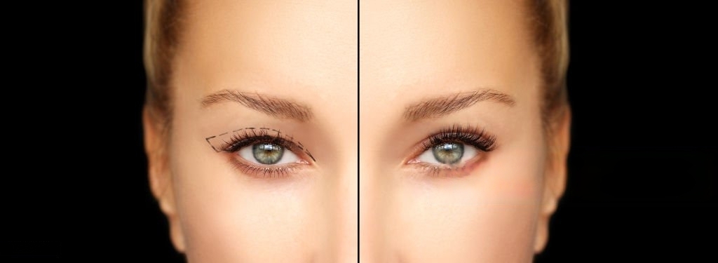 eyelid